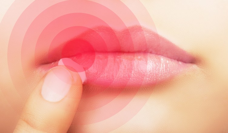 Woman  applying cream on lips affected by herpes, shown red.